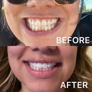 teeth whitening bay area campbell sanjose