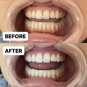 LED teeth whitening for sensitive teeth bronze palms campbell san jose santa clara