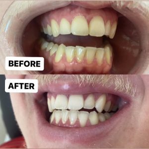 sensitivity free teeth whitening san jose campbell san francisco